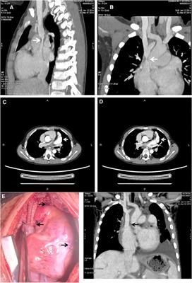 Radiofrequency ablation-induced superior vena cava stenosis in a 5-year-old boy with congenital left atrial appendage deformity: a case report and literature review